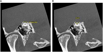 Predictors of non-primary auditory and vestibular symptom persistence following surgical repair of superior canal dehiscence syndrome